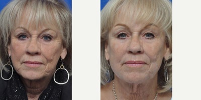 Dermabrasion before and after photo