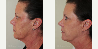 Laser Resurfacing before and after photo
