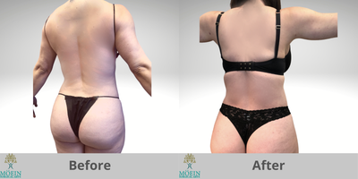 Smart Lipo before and after photo