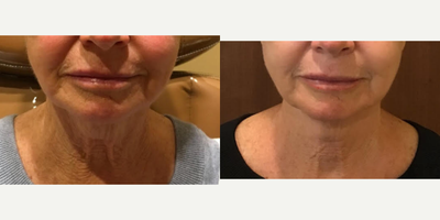 Thermage before and after photo