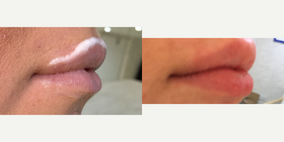 Volbella before and after photo
