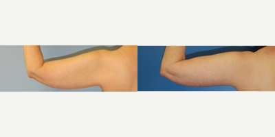 Arm Lift before and after photo