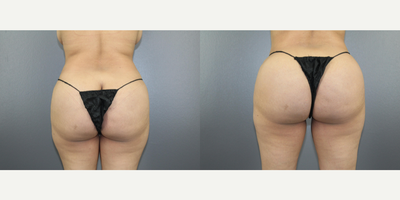 Brazilian Butt Lift before and after photo