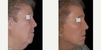 Facelift before and after photo