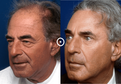 Hair Transplant before and after photo