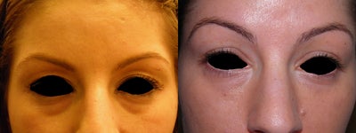 Juvederm before and after photo