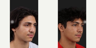 Septoplasty before and after photo