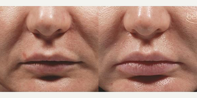 Bellafill before and after photo
