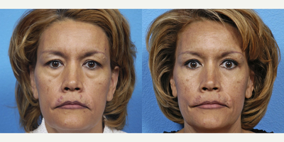 Eyelid Surgery before and after photo