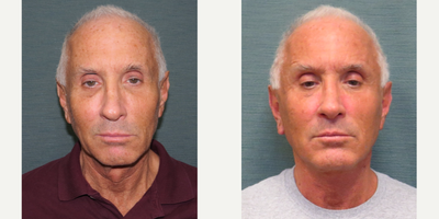 Facelift before and after photo