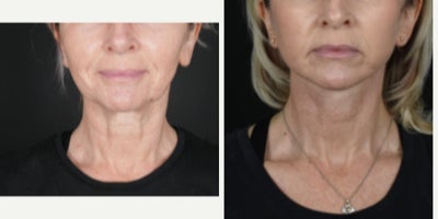 Facelift before and after photo