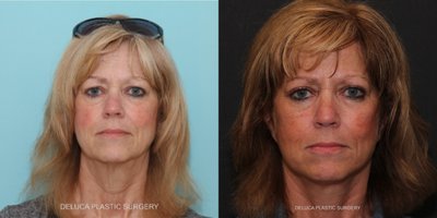 Eyelid Surgery before and after photo
