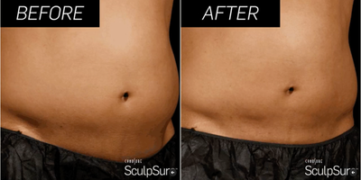 Laser Liposuction before and after photo