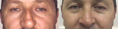 Rhinoplasty before and after photo