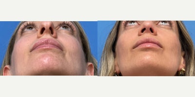 Rhinoplasty before and after photo