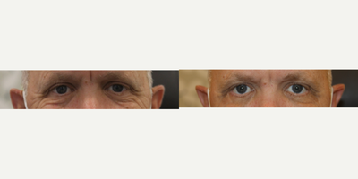 Eyelid Surgery before and after photo