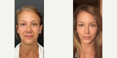 Neck Lift before and after photo
