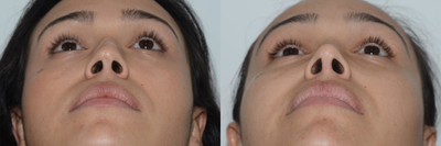 Revision Rhinoplasty before and after photo