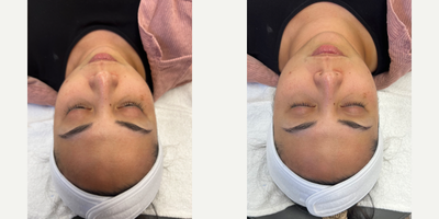DiamondGlow before and after photo