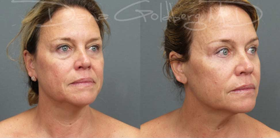 Eyelid Surgery before and after photo