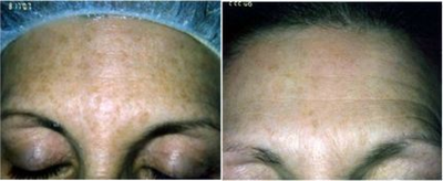 Fraxel Laser before and after photo