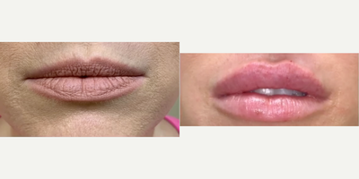 Lip Fillers before and after photo