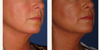 Nonsurgical Facelift before and after photo