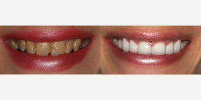 Porcelain Veneers before and after photo