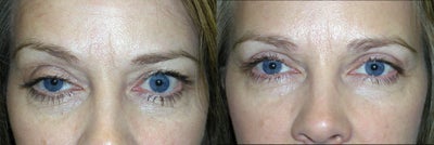 Ptosis Surgery before and after photo