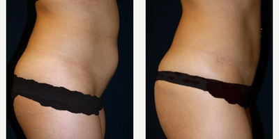 Tummy Tuck before and after photo