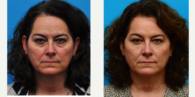 Botox before and after photo