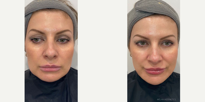 Chin Filler before and after photo