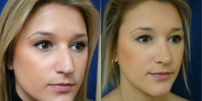 Rhinoplasty before and after photo