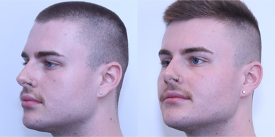 Buccal Fat Removal before and after photo