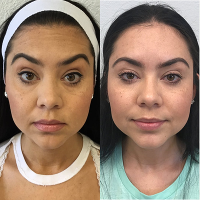 Dysport before and after photo
