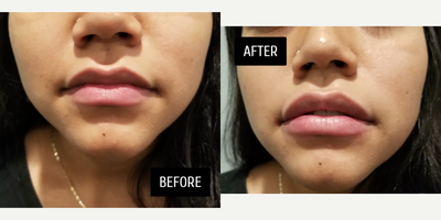 Juvederm before and after photo