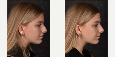 Nonsurgical Nose Job before and after photo
