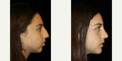 Rhinoplasty before and after photo