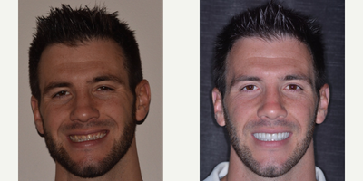 Smile Makeover before and after photo