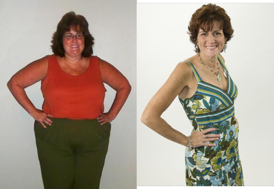 Gastric Bypass before and after photo