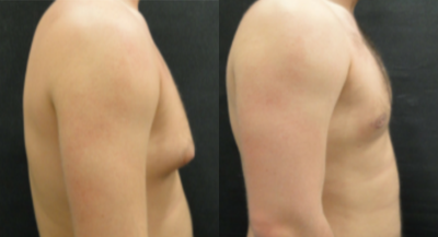 Gynecomastia Surgery before and after photo