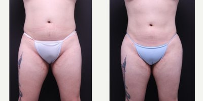 Liposuction before and after photo