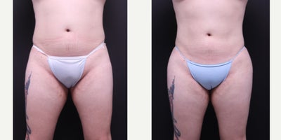 Liposuction before and after photo