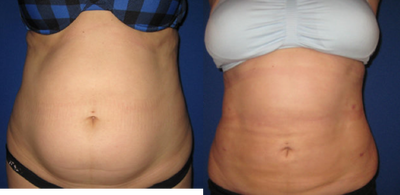 Smart Lipo before and after photo