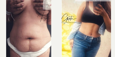 Tummy Tuck before and after photo