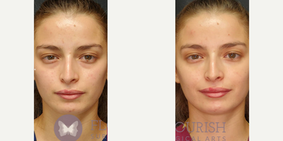 Volbella before and after photo