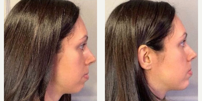 Chin Filler before and after photo
