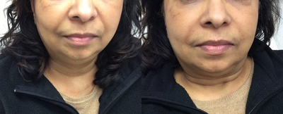 Dermal Fillers before and after photo