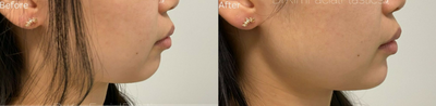 Dermal Fillers before and after photo