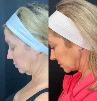 Nonsurgical Neck Lift before and after photo